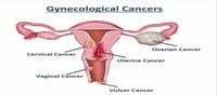 Gynecologic Cancer: Signs and Symptoms...